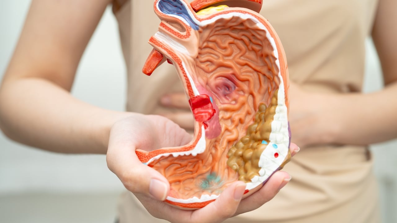 Stomach Ulcer Treatment