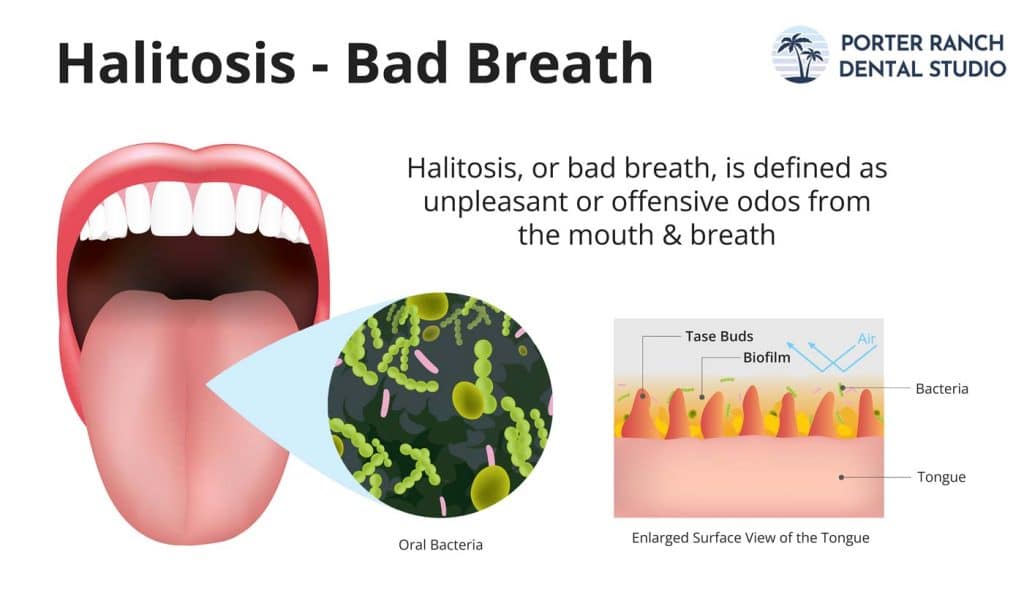 targeting the bacteria responsible for bad breath